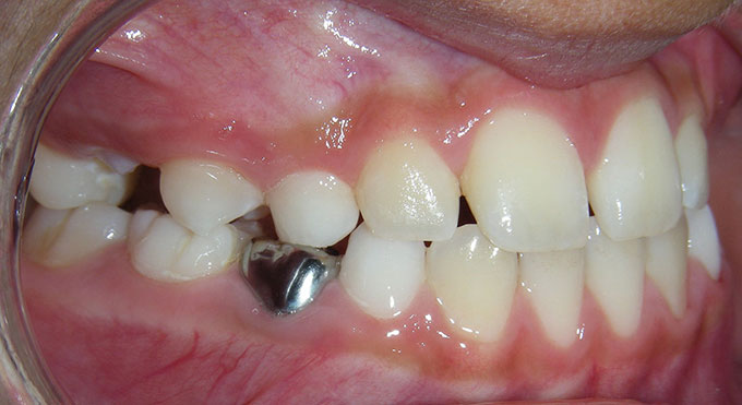 Teeth side view after treatment which consisted of an upper removable plate for 12 months 